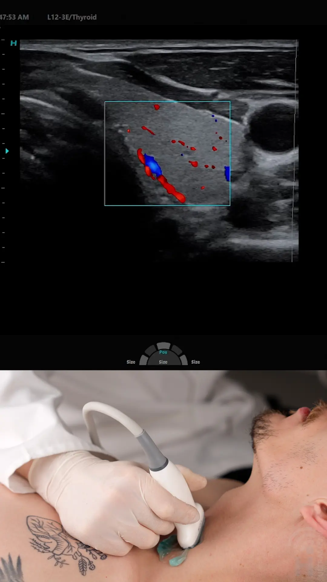 Hisense_tarczyca1_miniaturka